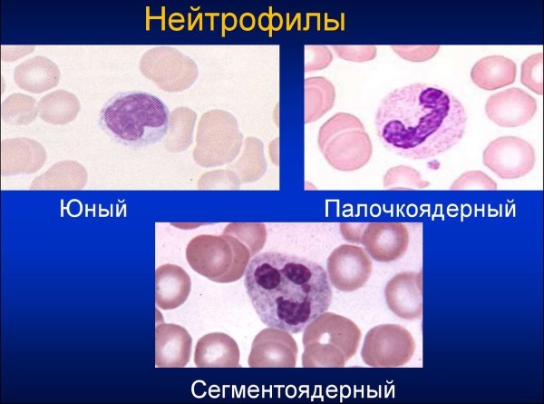 Нейтрофилы в крови у женщин. Норма по возрасту, при беременности, таблица