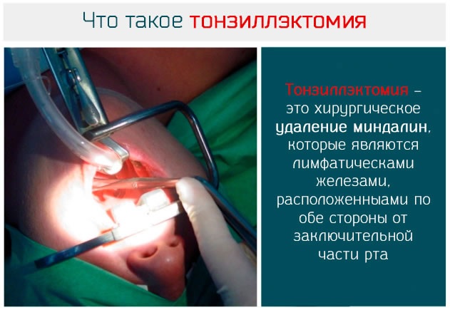 Как лечить горло ребенку 2 года при температуре и без