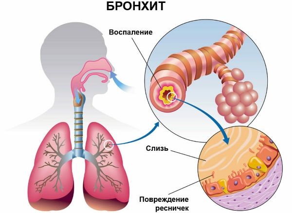 АЦЦ (ACC) сироп для детей. Цена, инструкция, дозировка, аналоги