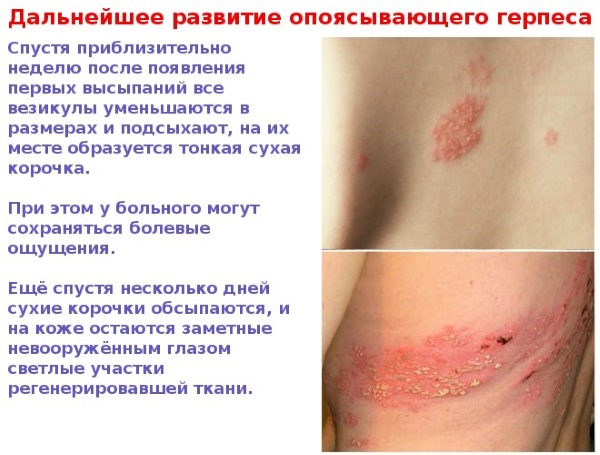 Опоясывающий герпес. Симптомы и лечение, народные средства, препараты антибиотики