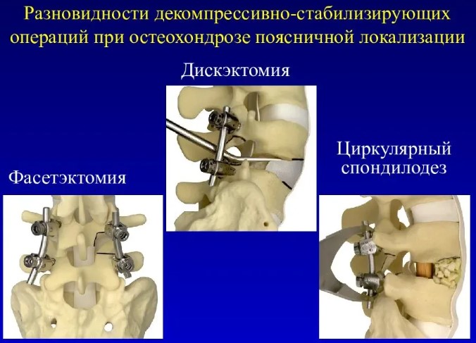 Остеофиты позвоночника, поясничного отдела. Лечение, как избавиться