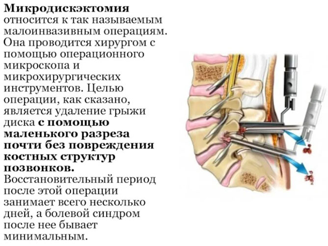 Остеофиты позвоночника, поясничного отдела. Лечение, как избавиться