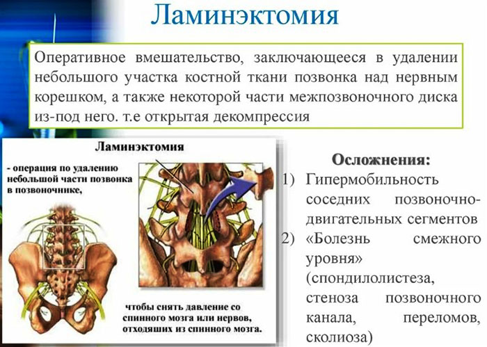Остеофиты позвоночника, поясничного отдела. Лечение, как избавиться
