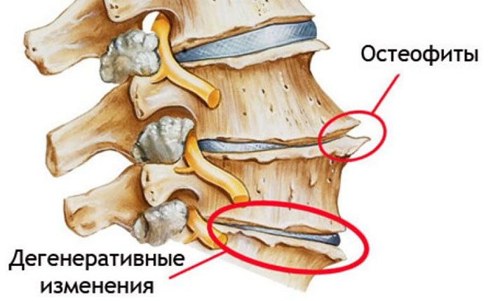 Остеофиты позвоночника, поясничного отдела. Лечение, как избавиться