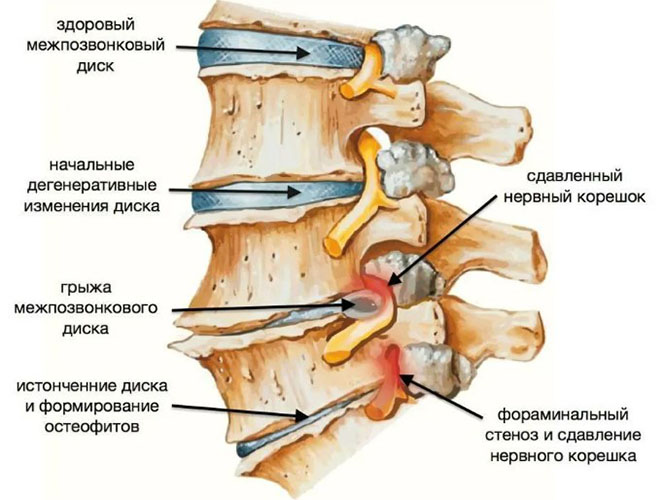 Остеофиты позвоночника, поясничного отдела. Лечение, как избавиться