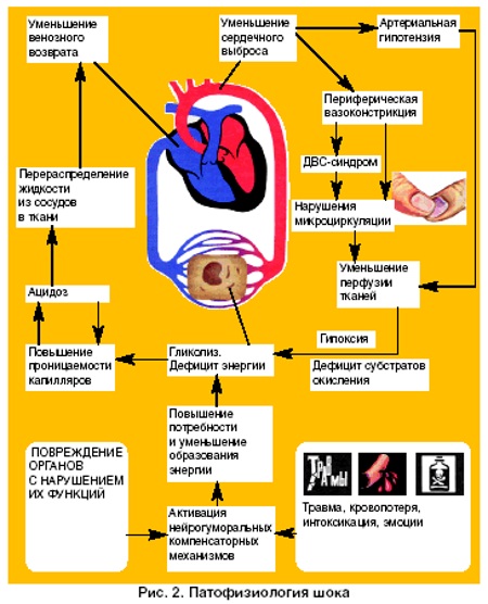 Острая сосудистая недостаточность (ОСдН). Что это такое, чем характеризуется, как проявляется