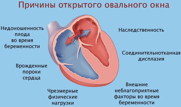 Овальное окно в сердце у новорожденного открыто. Что это, когда должно закрыться, последствия