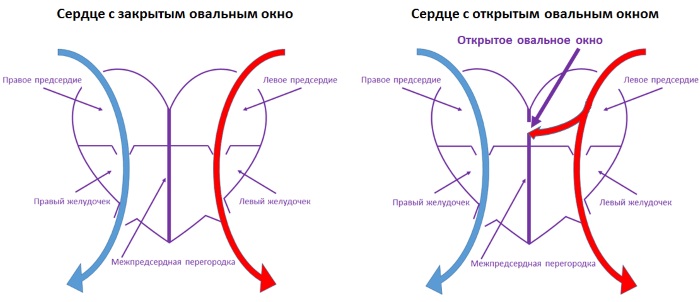 Овальное окно в сердце у новорожденного открыто. Что это, когда должно закрыться, последствия