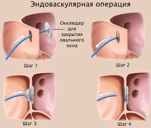 Овальное окно в сердце у новорожденного открыто. Что это, когда должно закрыться, последствия