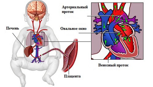 Овальное окно в сердце у новорожденного открыто. Что это, когда должно закрыться, последствия