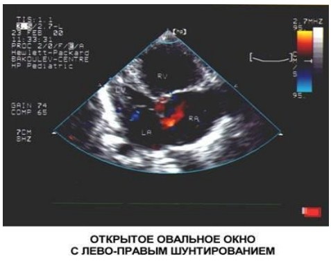 Овальное окно в сердце у новорожденного открыто. Что это, когда должно закрыться, последствия