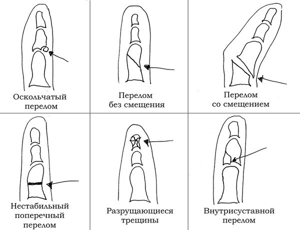 Перелом большого пальца на ноге. Симптомы, сколько заживает, как вылечить, нужен ли гипс, реабилитация