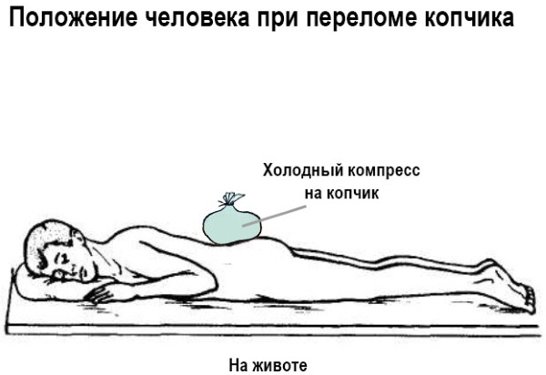Перелом копчика. Симптомы и последствия у женщин, ребенка, мужчин, чем лечить