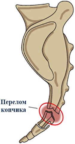 Перелом копчика. Симптомы и последствия у женщин, ребенка, мужчин, чем лечить