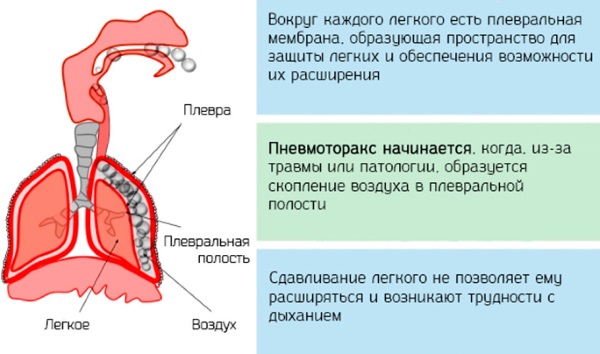 Перелом ребра. Симптомы, первая помощь, бандаж, лечение в домашних условиях, сколько заживает, осложнения