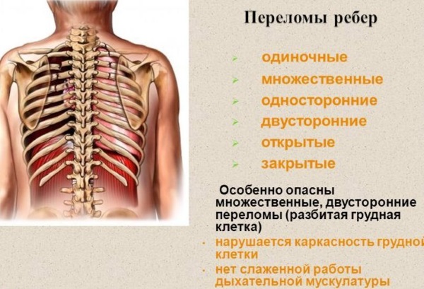 Перелом ребра. Симптомы, первая помощь, бандаж, лечение в домашних условиях, сколько заживает, осложнения