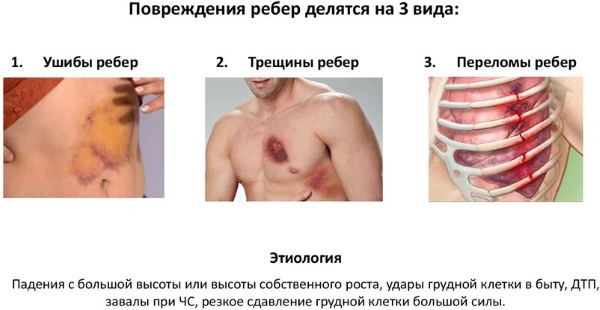 Перелом ребра. Симптомы, первая помощь, бандаж, лечение в домашних условиях, сколько заживает, осложнения