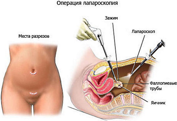Перевязка труб у женщин. Последствия для здоровья, побочные эффекты