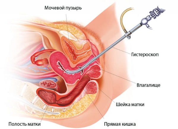 Перевязка труб у женщин. Последствия для здоровья, побочные эффекты