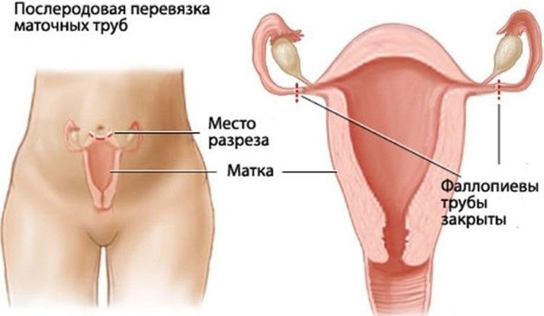 Перевязка труб у женщин. Последствия для здоровья, побочные эффекты