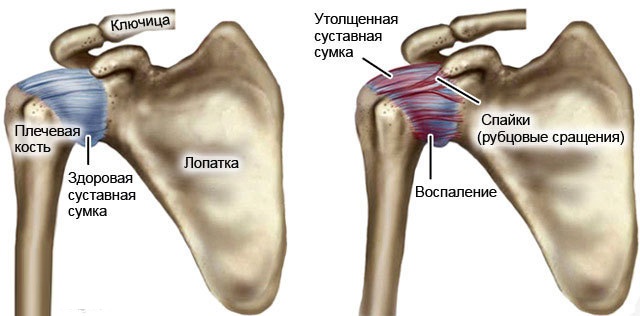Периартрит плечевого сустава. Лечение, симптомы, гимнастика, таблетки