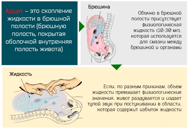 Синдром мальабсорбции. Что это у детей, взрослых, симптомы, рекомендации, лечение