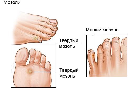 Пластырь от мозолей на ногах: сухих, влажных, натоптышей со стержнем, между пальцами: Компид, Салипод, силиконовый, гелевый