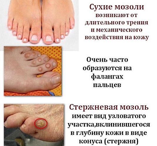Пластырь от мозолей на ногах: сухих, влажных, натоптышей со стержнем, между пальцами: Компид, Салипод, силиконовый, гелевый