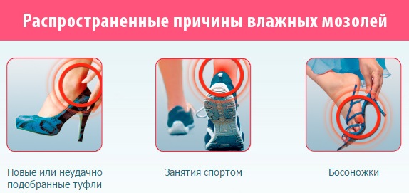 Пластырь от мозолей на ногах: сухих, влажных, натоптышей со стержнем, между пальцами: Компид, Салипод, силиконовый, гелевый