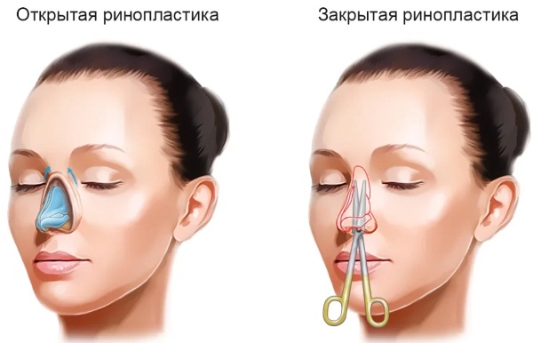 Положение Тренделенбурга. Что это такое, как применяется при операциях, рентгене, анафилактическом шоке