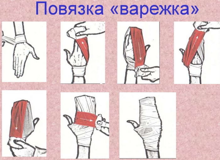 Повязка варежка на кисть. Алгоритм, техника наложения, показания