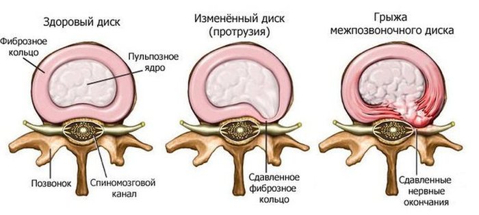 Мечевидный отросток грудины. Фото, где находится, болит при надавливании, увеличился, симптомы воспаления, лечение