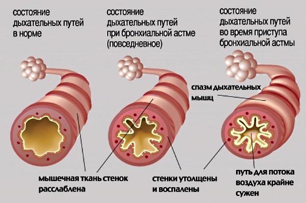 Боль в грудной клетке при кашле с левой, правой стороны, посередине. Что это, причины, лечение