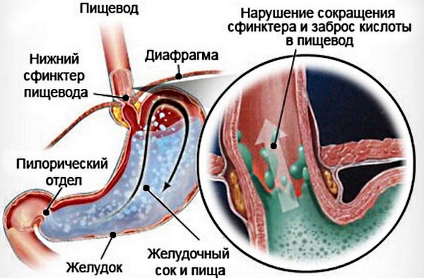 Боль в грудной клетке при кашле с левой, правой стороны, посередине. Что это, причины, лечение