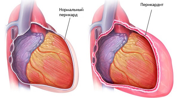 Боль в грудной клетке при кашле с левой, правой стороны, посередине. Что это, причины, лечение