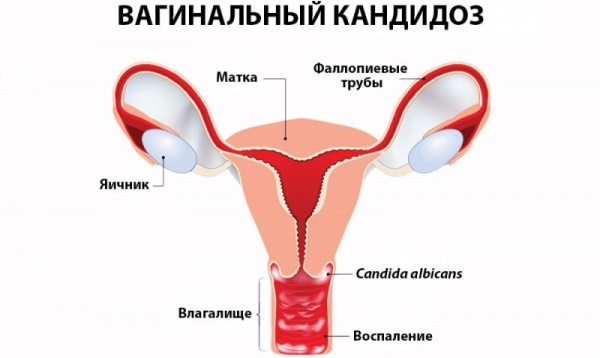 Противогрибковые препараты в таблетках недорогие, но эффективные, широкого спектра действия