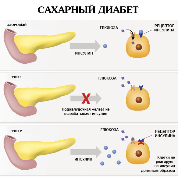 Олиджим таблетки для диабетиков. Отзывы, инструкция, состав, цена