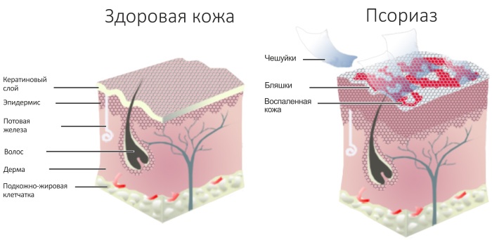 Лечение псориаза народными средствами в домашних условиях