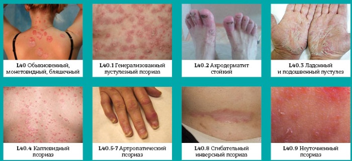 Лечение псориаза народными средствами в домашних условиях