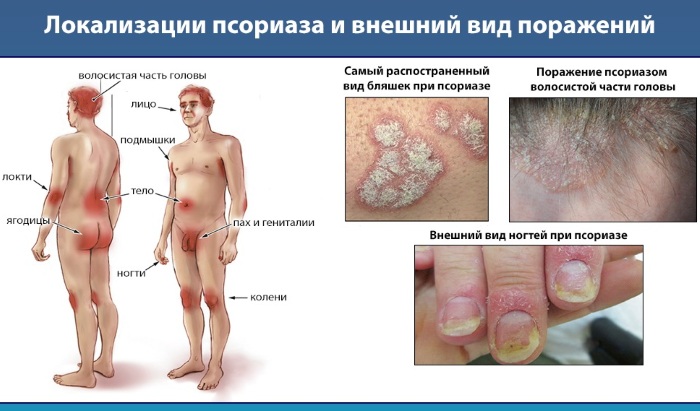 Лечение псориаза народными средствами в домашних условиях