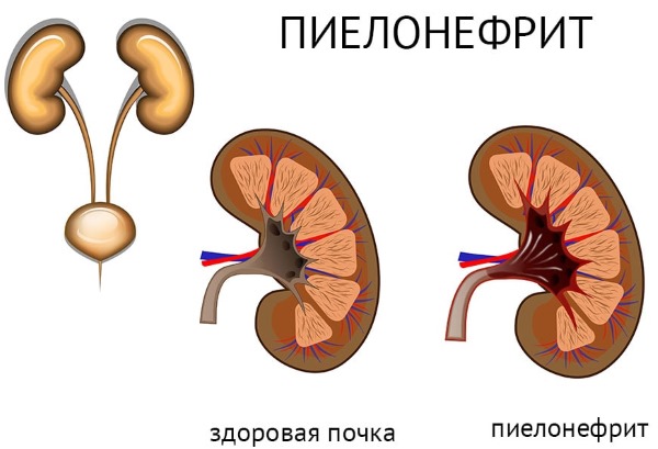 Радоновые ванны. Польза, показания и противопоказания для мужчин, женщин в гинекологии