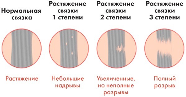 Растяжение икроножной мышцы. Лечение, симптомы, что делать, первая помощь