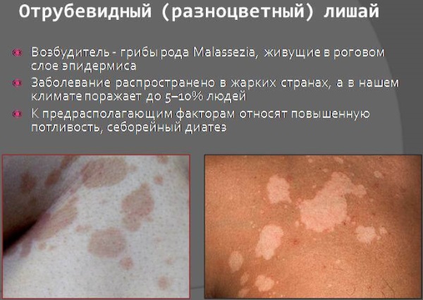 Разновидности лишая у человека. Фото, описание, симптомы и лечение