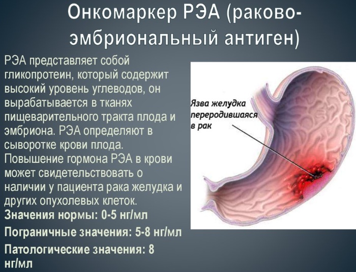 РЭА онкомаркер. Норма у женщин по возрасту, расшифровка, что показывает