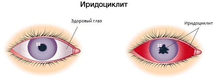 Рус токсикодендрон (Rhus toxicodendron) гомеопатия. Инструкция, показания к применению, отзывы