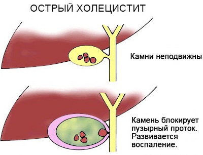РОЭ норма в крови у женщин по возрасту. Таблица после 40 лет, оседание, что значит повышенное, причины и лечение
