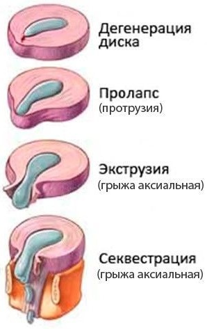 Секвестрация грыжи межпозвоночного диска. Что это такое, симптомы, лечение