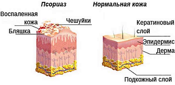 Рейтинг лучших шампуней от псориаза на голове: Псорилом, Лостерин, Скин кап, Этривекс, Кето плюс, 911, Либридерм цинк