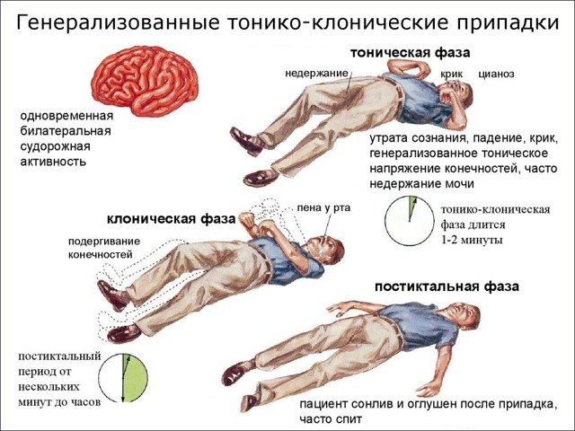 Эмболия околоплодными водами при кесаревом сечении. Причины, что это, прогноз и лечение