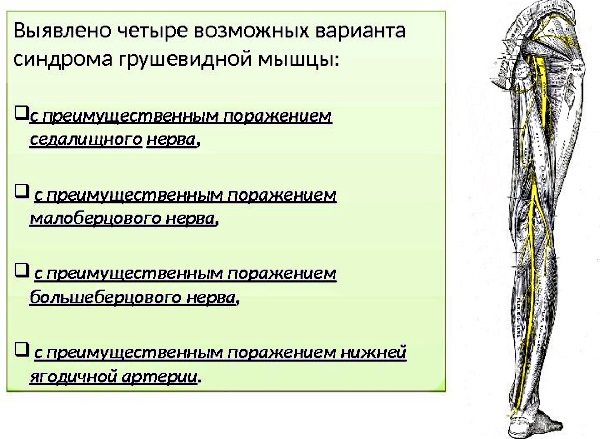 Синдром грушевидной мышцы. Симптомы и лечение, гимнастика в домашних условиях